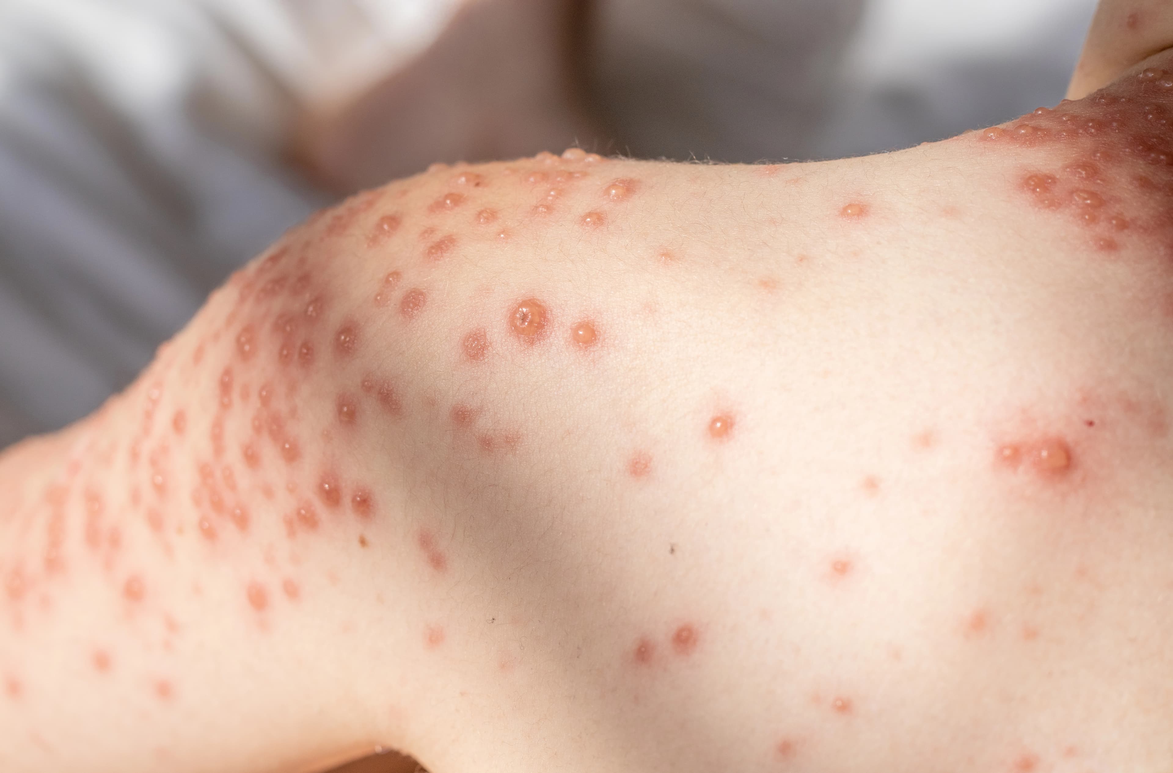 病毒性皮膚問題