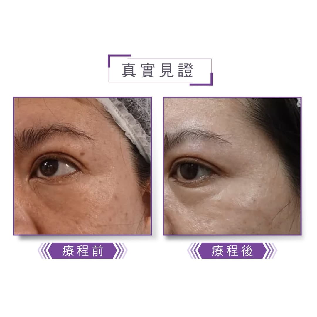 脫疣治療前後對比案例一