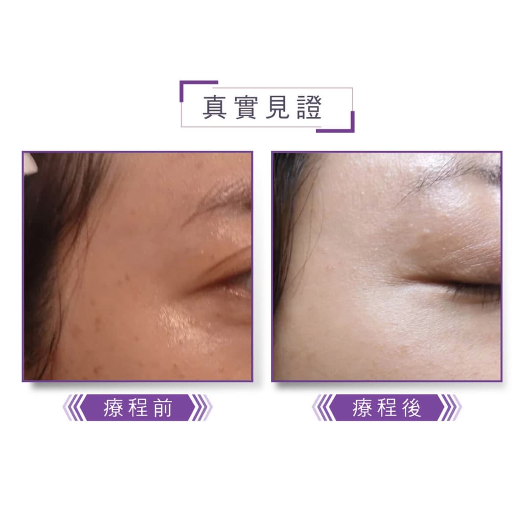 脫疣治療前後對比案例二