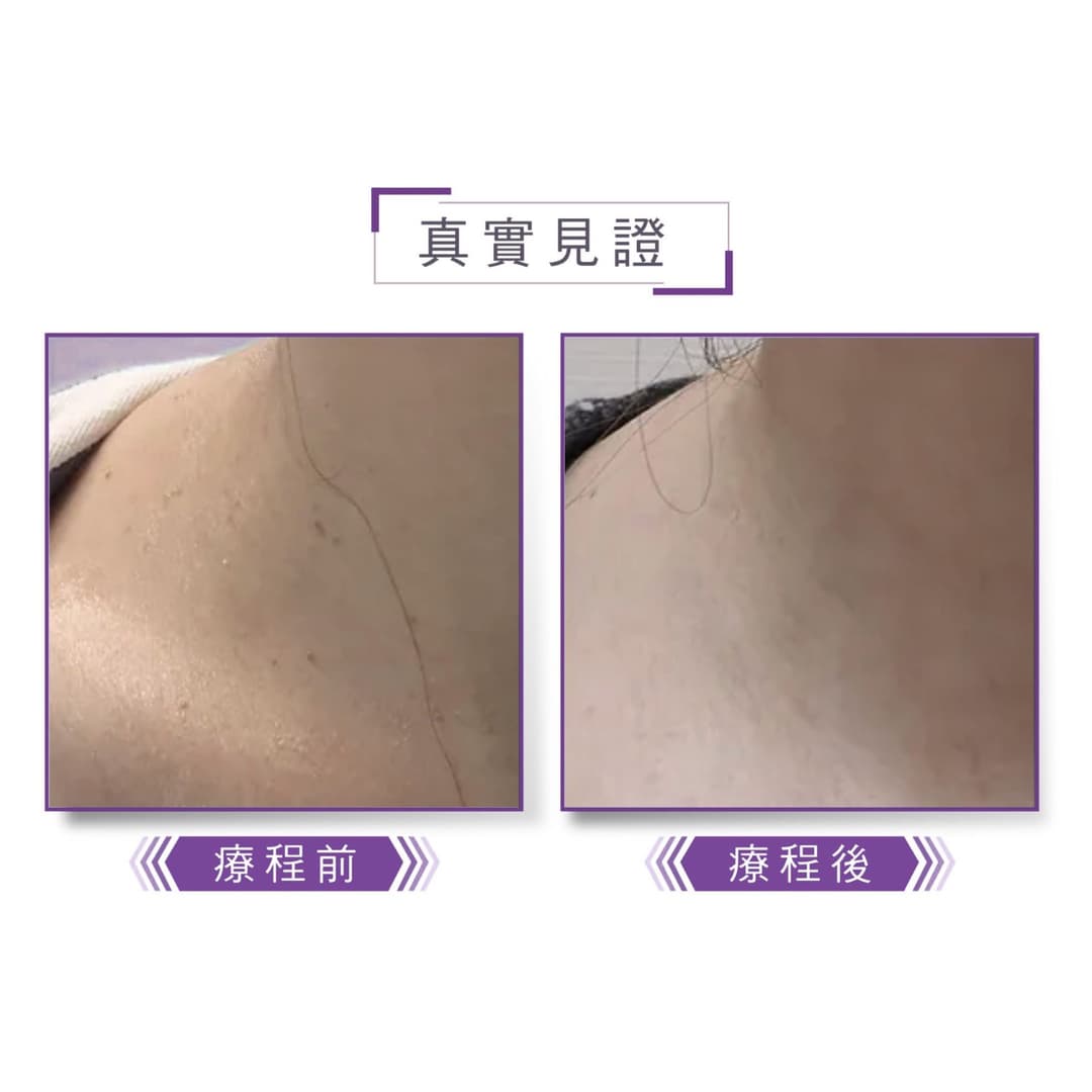 脫疣治療前後對比案例三