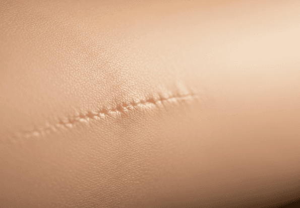 A macro shot showing smooth, healthy skin texture with a faint, healed scar, symbolizing successful skin recovery.