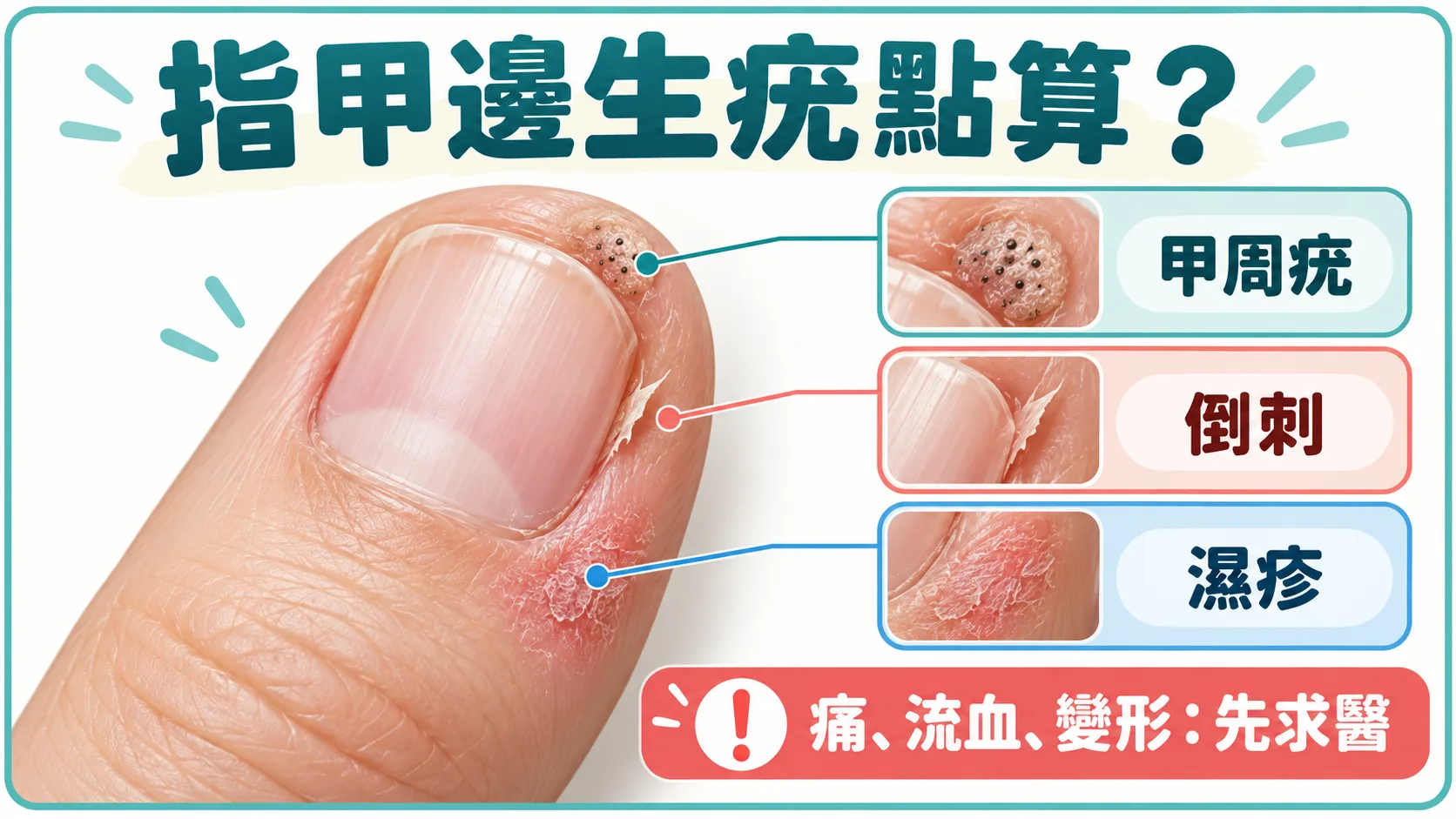 甲周疣倒刺濕疹與求醫警號位置圖解